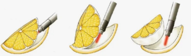 энуклеация