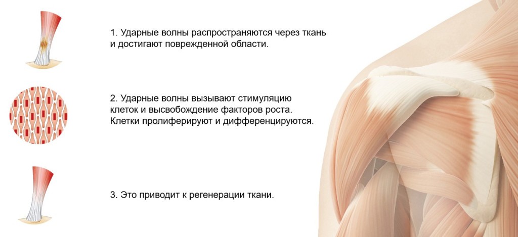 Механика действия УВТ Механика действия УВ_medcub