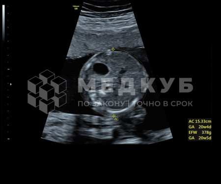 Аппарат УЗИ (сканер) GE Healthcare Voluson S8 medcub