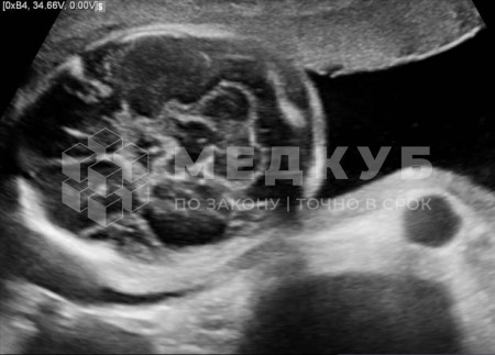 Аппарат УЗИ НПО Сканер РуСкан 65 medcub