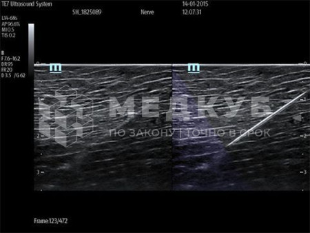 Портативный аппарат УЗИ Mindray TE7 (планшет) medcub