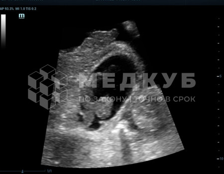 Аппарат УЗИ (сканер) Mindray Resona 6 medcub