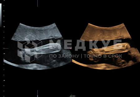 Аппарат УЗИ (сканер) GE Healthcare Voluson S10 medcub