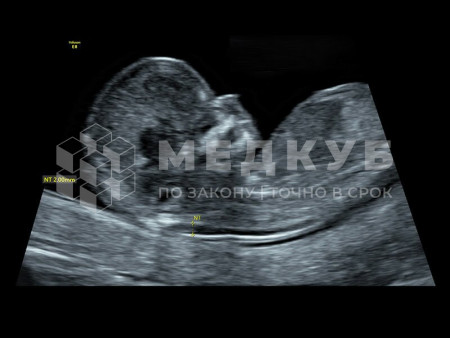 Аппарат УЗИ (сканер) GE Healthcare Voluson S10 medcub