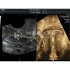 Аппарат УЗИ (сканер) GE Healthcare Voluson P8 medcub