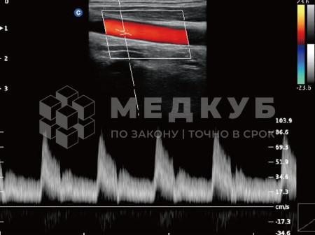 Аппарат УЗИ (сканер) Chison QBit 5 medcub