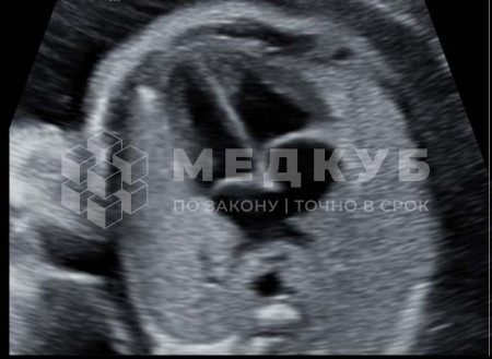 Аппарат УЗИ НПО Сканер РуСкан 65М medcub