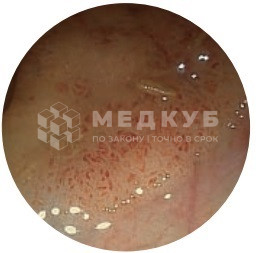 Видеоэндоскопическая система SonoScape HD-550 medcub