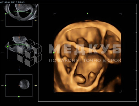 Аппарат УЗИ (сканер) Mindray Resona 7s medcub