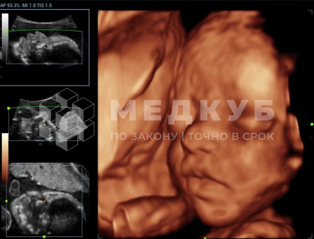 Аппарат УЗИ (сканер) Mindray Resona 7s medcub