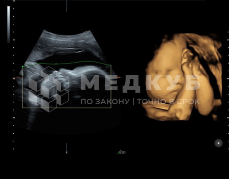 Аппарат УЗИ (сканер) GE Healthcare Voluson S8 medcub