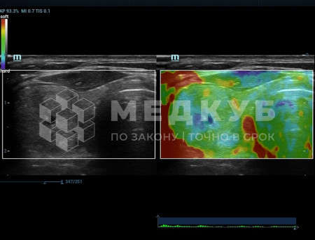 Аппарат УЗИ (сканер) Mindray Resona 7s medcub