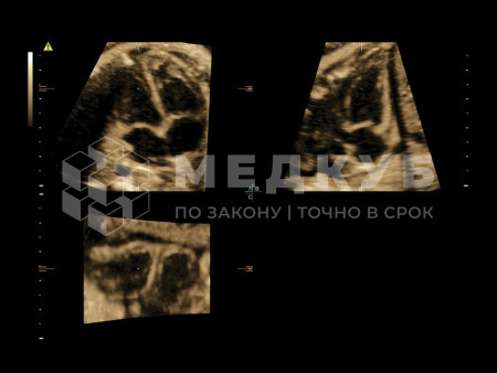 Аппарат УЗИ (сканер) GE Healthcare Voluson E10 medcub