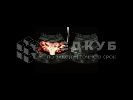 Аппарат УЗИ (сканер) Chison Qbit 12 medcub