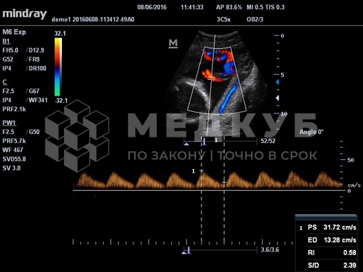Аппарат УЗИ (сканер) Mindray M5 new