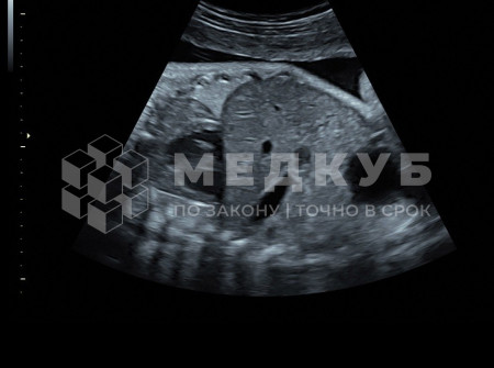 Аппарат УЗИ (сканер) GE Healthcare Voluson S8 medcub