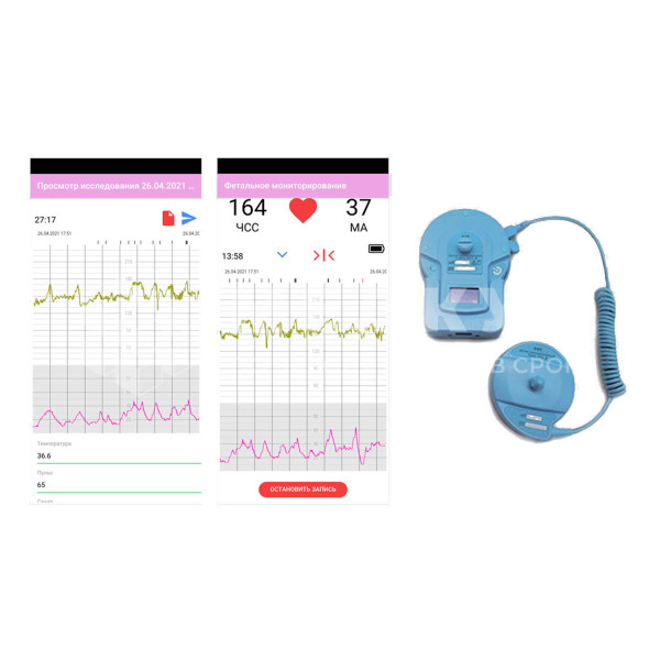 Система дистанционного кардиотокографического мониторирования БИОСС ФМП medcub