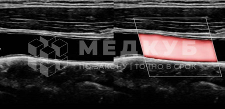 Аппарат УЗИ НПО Сканер РуСкан 65 medcub