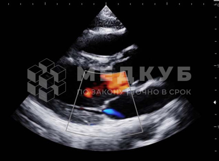 Аппарат УЗИ НПО Сканер РуСкан 65 medcub