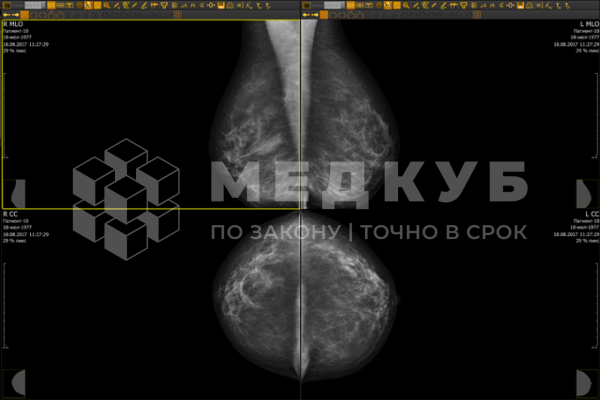 Маммограф рентгеновский биопсийный МТЛ Маммо-5МТ medcub