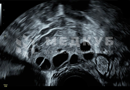 Аппарат УЗИ (сканер) GE Healthcare Voluson S10 medcub