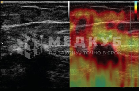 УЗИ-аппарат портативный НПО Сканер РуСкан 70П medcub