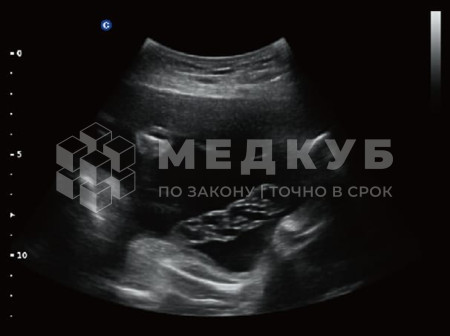 Аппарат УЗИ (сканер) Chison QBit 5 medcub