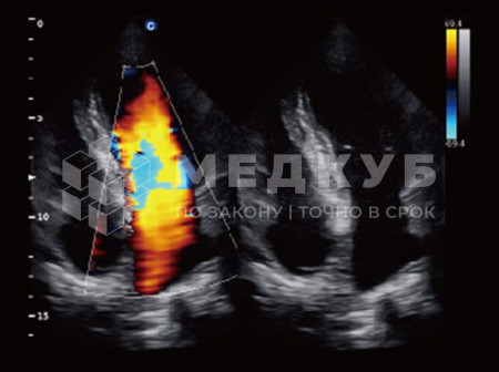Аппарат УЗИ (сканер) Chison QBit 5 medcub