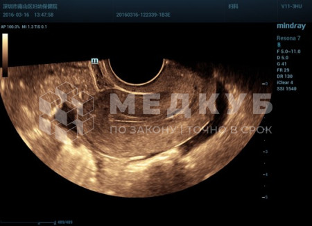 Аппарат УЗИ (сканер) Mindray Resona 7s medcub