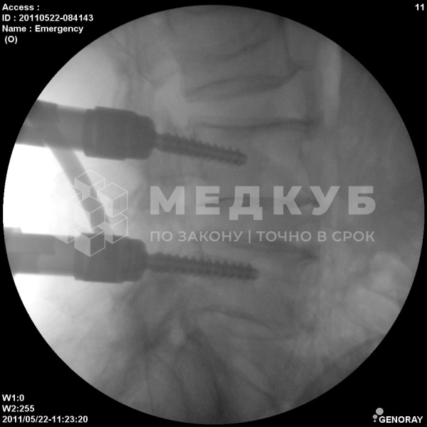Мобильный рентгенохирургический аппарат типа С-дуга С.П. Гелпик Ренекс 5,3 кВт с цифровым УРИ medcub