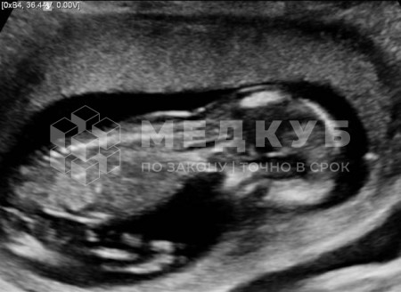 Аппарат УЗИ НПО Сканер РуСкан 65 medcub