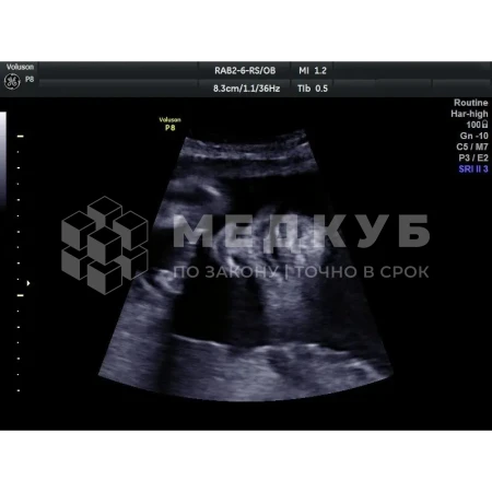 Аппарат УЗИ (сканер) GE Healthcare Voluson P8 medcub