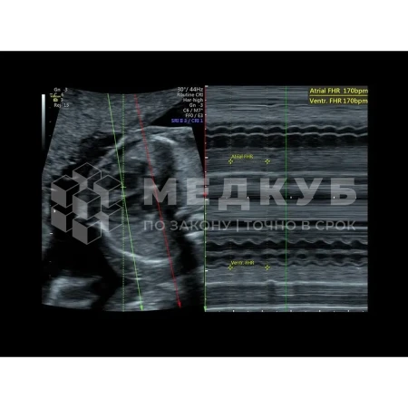Аппарат УЗИ (сканер) GE Healthcare Voluson P8 medcub