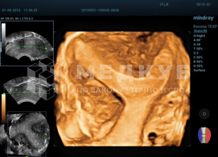 Аппарат УЗИ (сканер) Mindray Resona 7s medcub