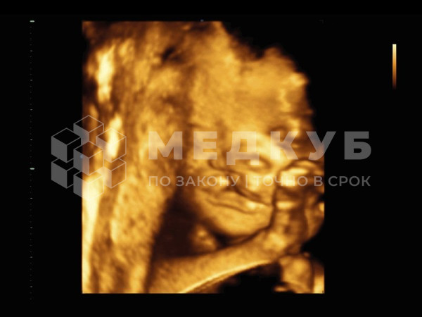 Аппарат УЗИ НПО Сканер РуСкан 50 medcub