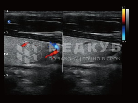 Аппарат УЗИ (сканер) Chison QBit 5 medcub
