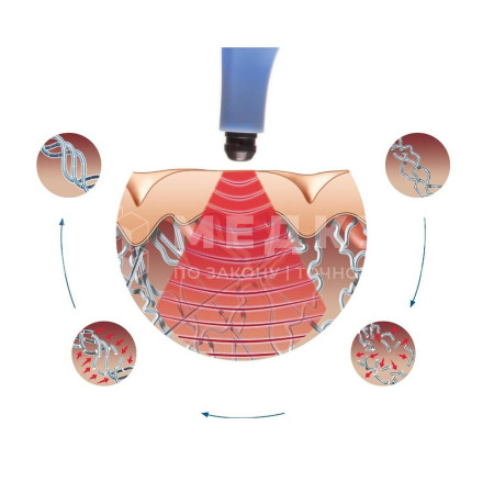 Аппарат RF-лифтинга BTL EXILIS Ultra 360 medcub