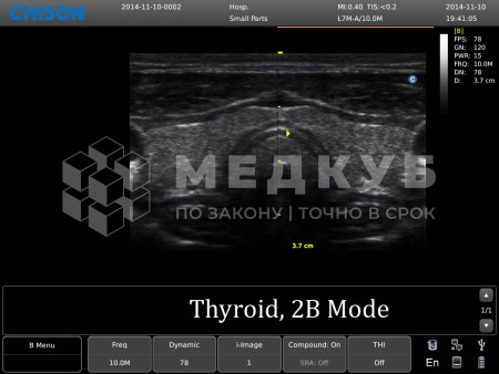 Аппарат УЗИ (сканер) Chison SonoTouch 10 medcub