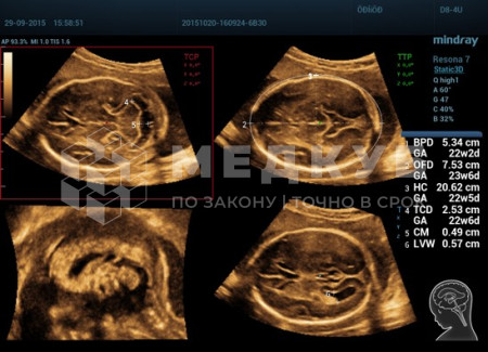 Аппарат УЗИ (сканер) Mindray Resona 7s medcub