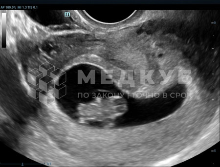 Аппарат УЗИ (сканер) Mindray Resona 6 medcub