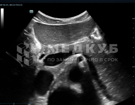 Аппарат УЗИ (сканер) Mindray Resona 6 medcub