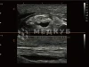 Аппарат УЗИ (сканер) Chison SonoTouch 80 Expert medcub