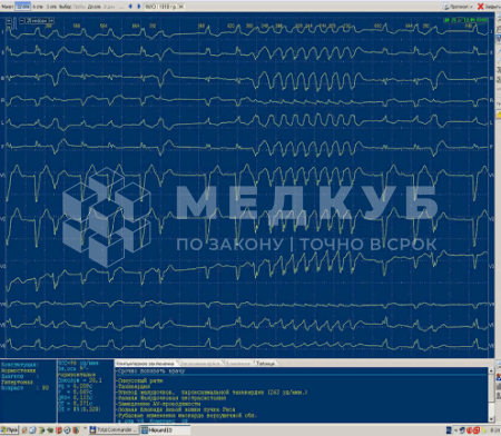 Компьютерный электрокардиограф (ЭКГ) НИМП ЕСН Миокард-12 medcub