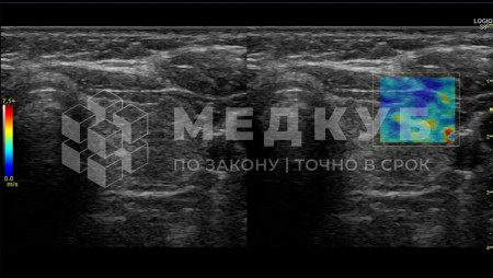 Аппарат УЗИ (сканер) GE Healthcare Logiq S8 medcub