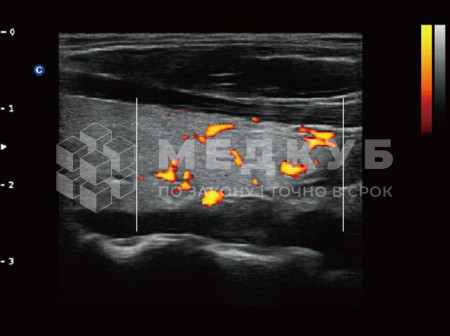 Аппарат УЗИ (сканер) Chison QBit 5 medcub