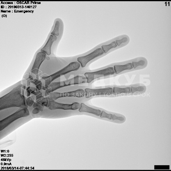 Мобильный рентгенохирургический аппарат типа С-дуга С.П. Гелпик Ренекс 5,3 кВт с цифровым плоскопанельным детектором medcub