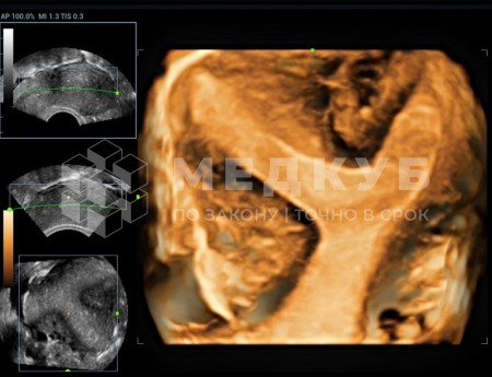 Аппарат УЗИ (сканер) Mindray Resona 6 medcub