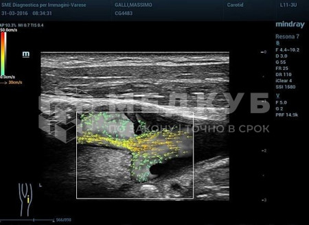 Аппарат УЗИ (сканер) Mindray Resona 7s medcub