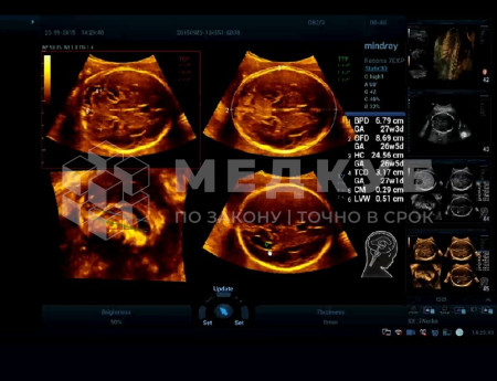 Аппарат УЗИ (сканер) Mindray Resona 7s medcub