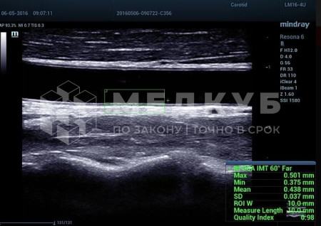 Аппарат УЗИ (сканер) Mindray Resona 7s medcub